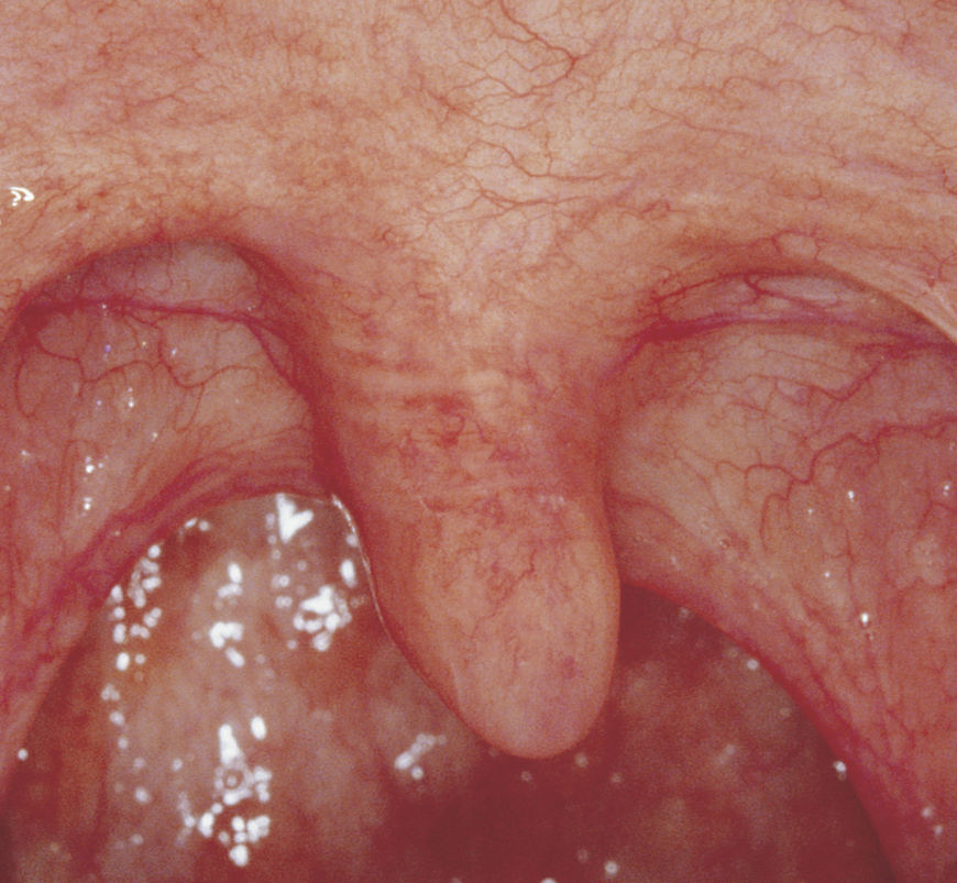 IMAGE: Photography – tonsils